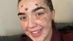 "بشرتي تجعلني مميزة وأتعلم تقبّلها"