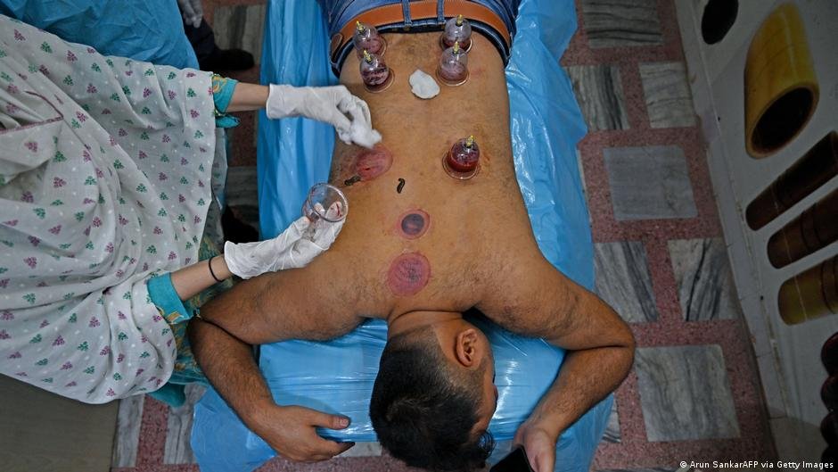 هل تنجح الحجامة في تخفيف الألم؟