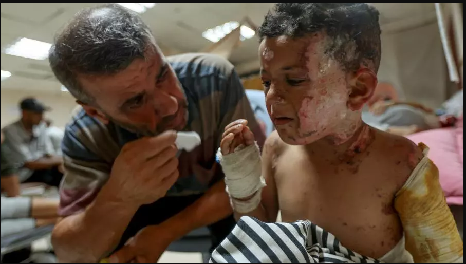 قيود الاحتلال توقف إنتاج أقنعة علاج الحروق في غزة